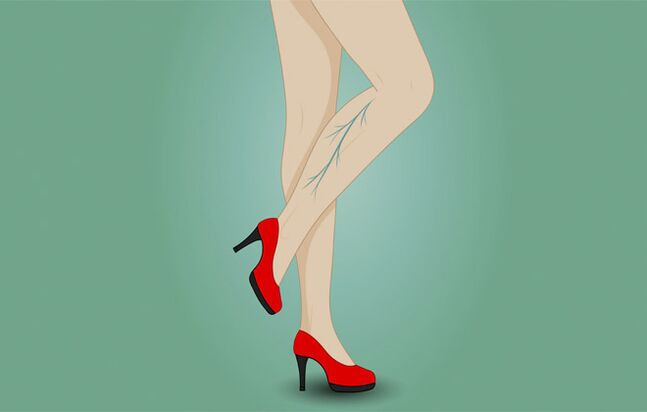 Venas varicosas en las piernas de una mujer