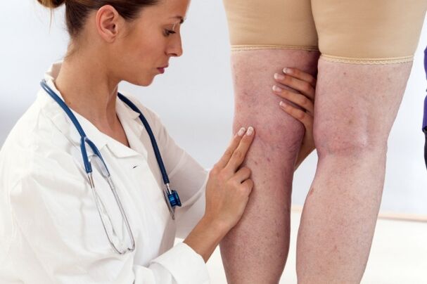 Tratamiento de las venas varicosas en mujeres