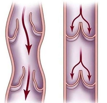 Varices