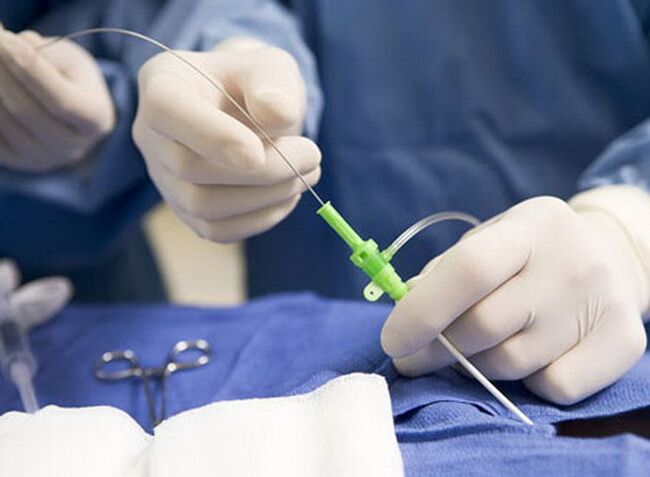 ablación por radiofrecuencia