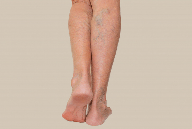 venas varicosas en las piernas