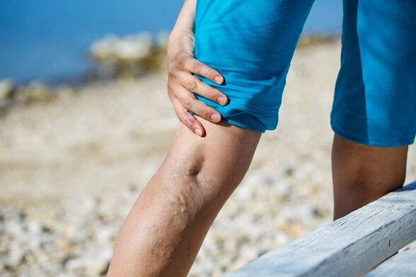 Dolor persistente en las piernas con venas varicosas.