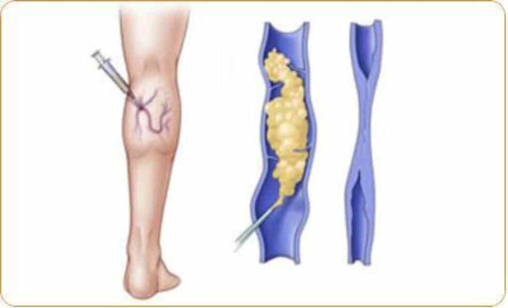 Un ejemplo del procedimiento de escleroterapia para las varices y un resultado claro. 